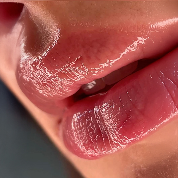 Increased Lip Volume