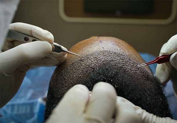 Hair Transplant Procedure Step 1