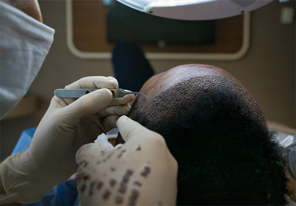 Hair Transplant Procedure Step 2