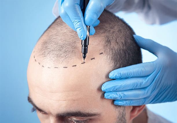Hair Transplant Procedure Step 3