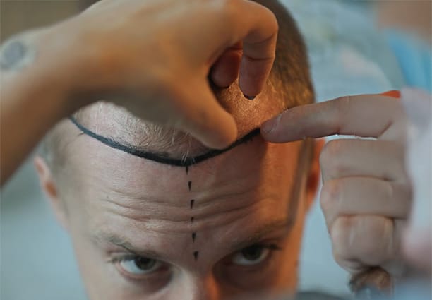 Hair Transplant Procedure Step 5