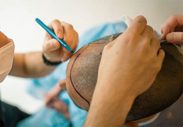 Hair Transplant Procedure Step 6