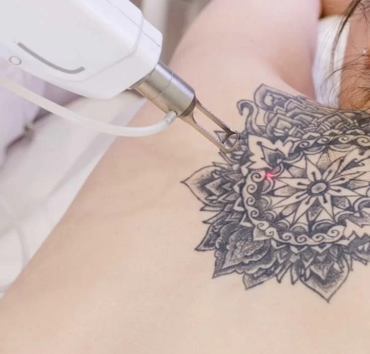 Tattoo Removal