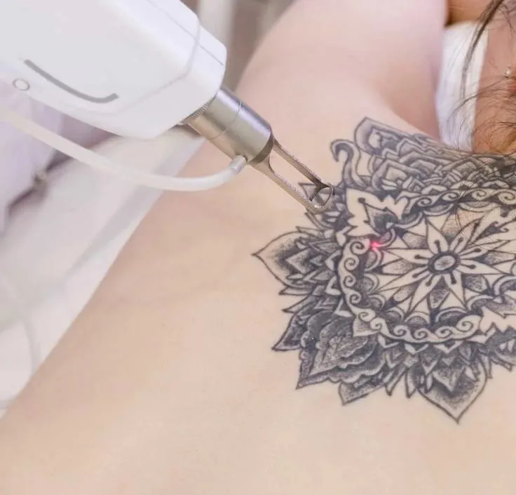 Tattoo Removal